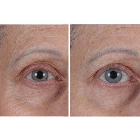 Cold Plasma Plus+ The Essence Bild 2