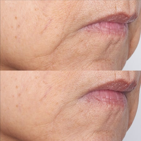 Cold Plasma Plus+ The Intensive Gel Mask Bild 3